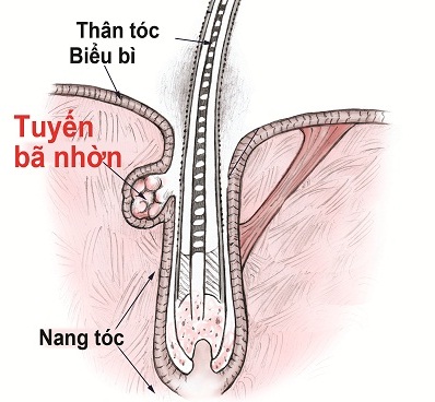 DHT – “Thủ phạm giấu mặt” của chứng rụng tóc 2