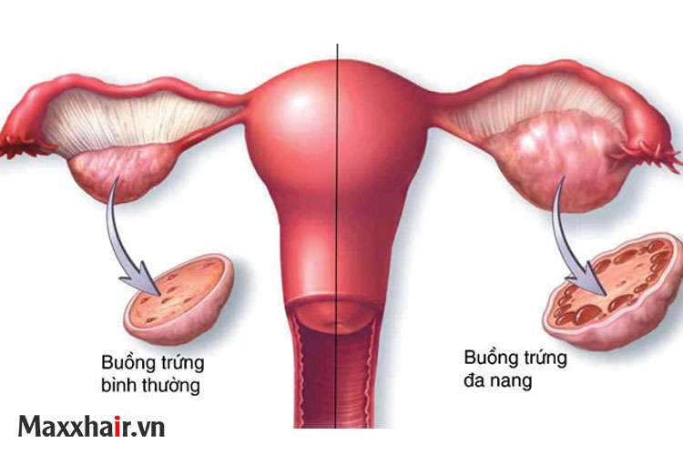 Hội chứng buồng trứng đa nang 1