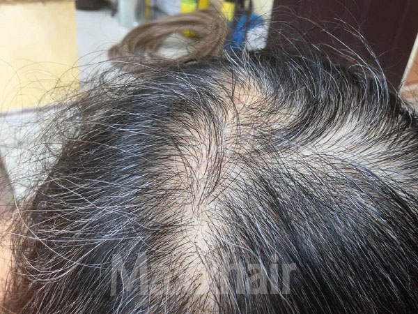 Tóc rụng nhiều "sắp hói" thử ngay cách này 2 lần mỗi ngày