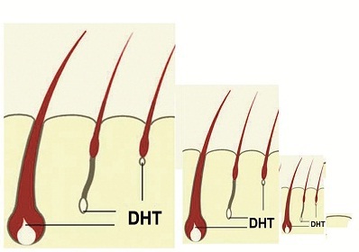 80% trường hợp rụng tóc, hói đầu ở cả nam nữ là do nguyên nhân này 1