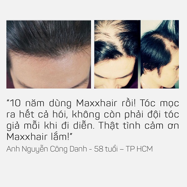 Ai đã sử dụng Maxxhair? 2