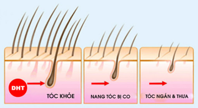 PGS.TS.BS Phạm Hoàng Khâm giải thích nguyên nhân rụng tóc, hói đầu ở phụ nữ trung tuổi 2