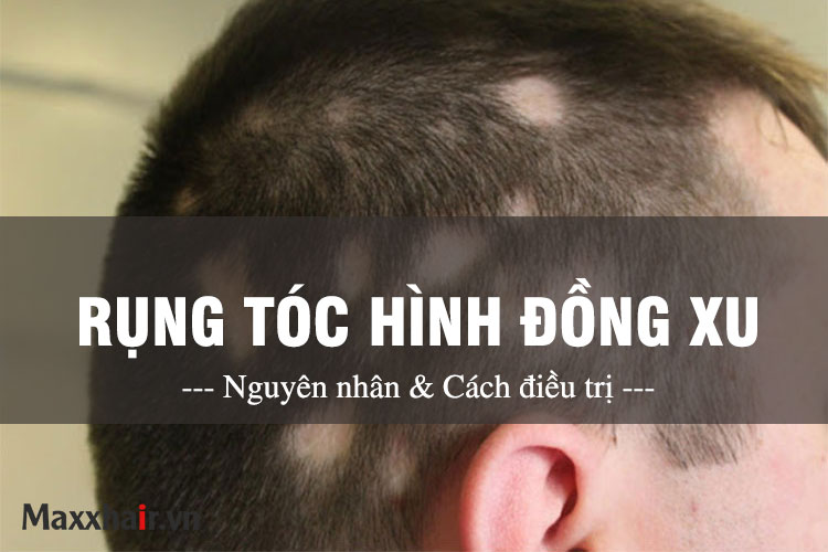 Rụng tóc hình đồng xu - Nguyên nhân và cách điều trị 1