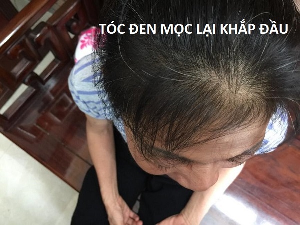 Tóc khoẻ, đen và dày đến già chỉ nhờ mẹo đơn giản này. Áp dụng ngay!