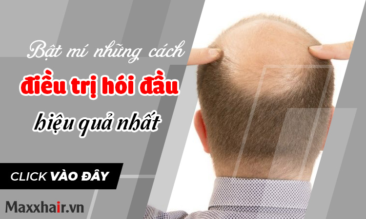 Tìm hiểu chi tiết các phương pháp điều trị hói đầu hiện nay