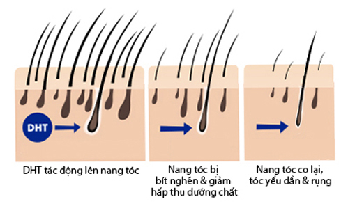 Tại sao tóc rụng nhiều bất thường dẫn đến tình trạng tóc thưa, hói? 1