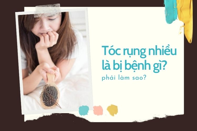 Tóc rụng nhiều cảnh báo bệnh gì?