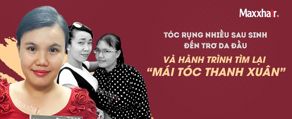 Tóc rụng nhiều sau sinh đến trơ da đầu và hành trình tìm lại “mái tóc thanh xuân” 1