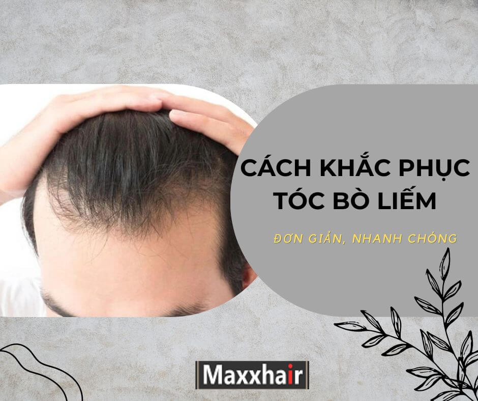 Tóc bò liếm là tóc mọc xoáy ở trán và mọc theo nhiều hướng