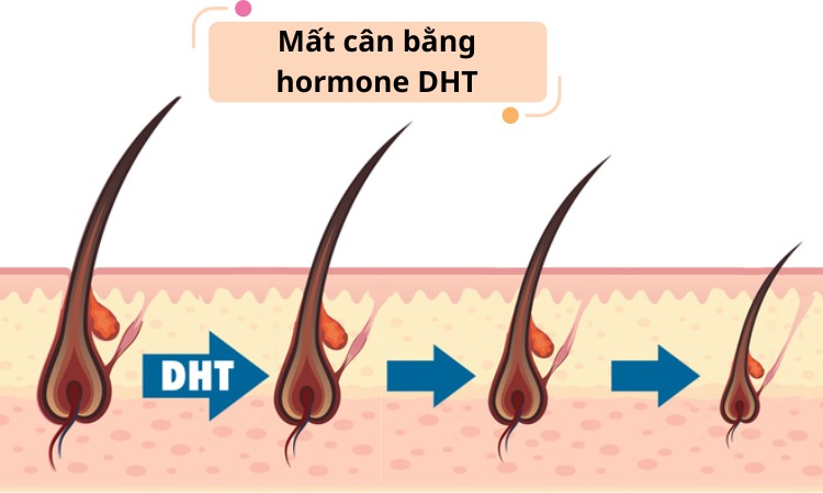 Hormone DHT mất cân bằng khiến nang tóc bị thu nhỏ và yếu