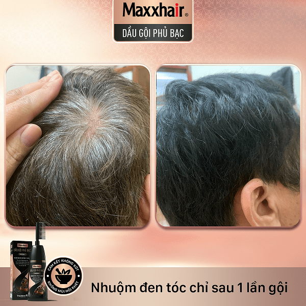 Khách hàng đã gội nhuộm đen tóc từ Dầu gội phủ bạc Maxxhair 1