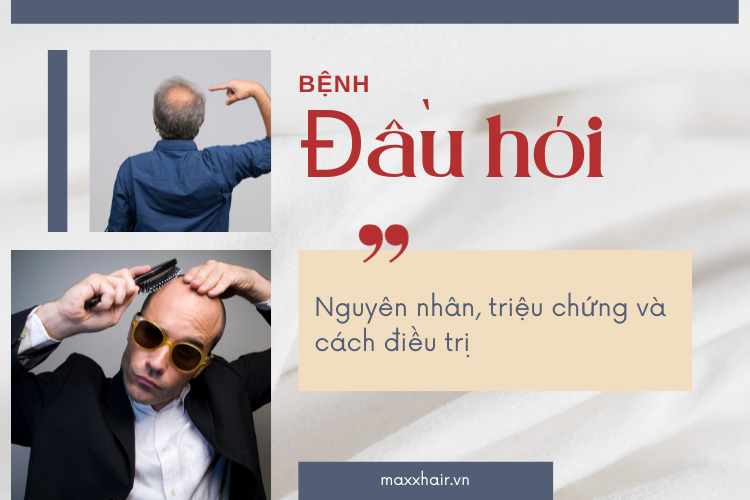 Bệnh đầu hói: Nguyên nhân, triệu chứng & cách điều trị