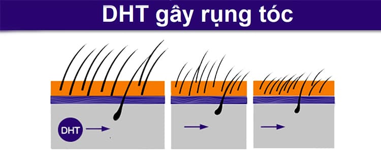 Hormone DHT ảnh hưởng lớn đến quá trình mọc tóc